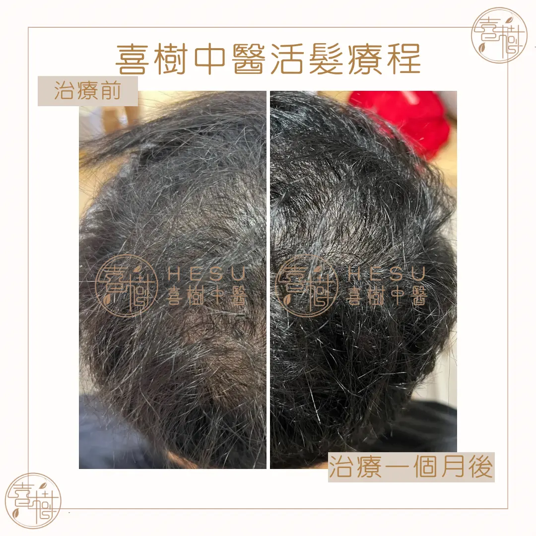 Alt="男士地中海脫髮治療前後對比效果"