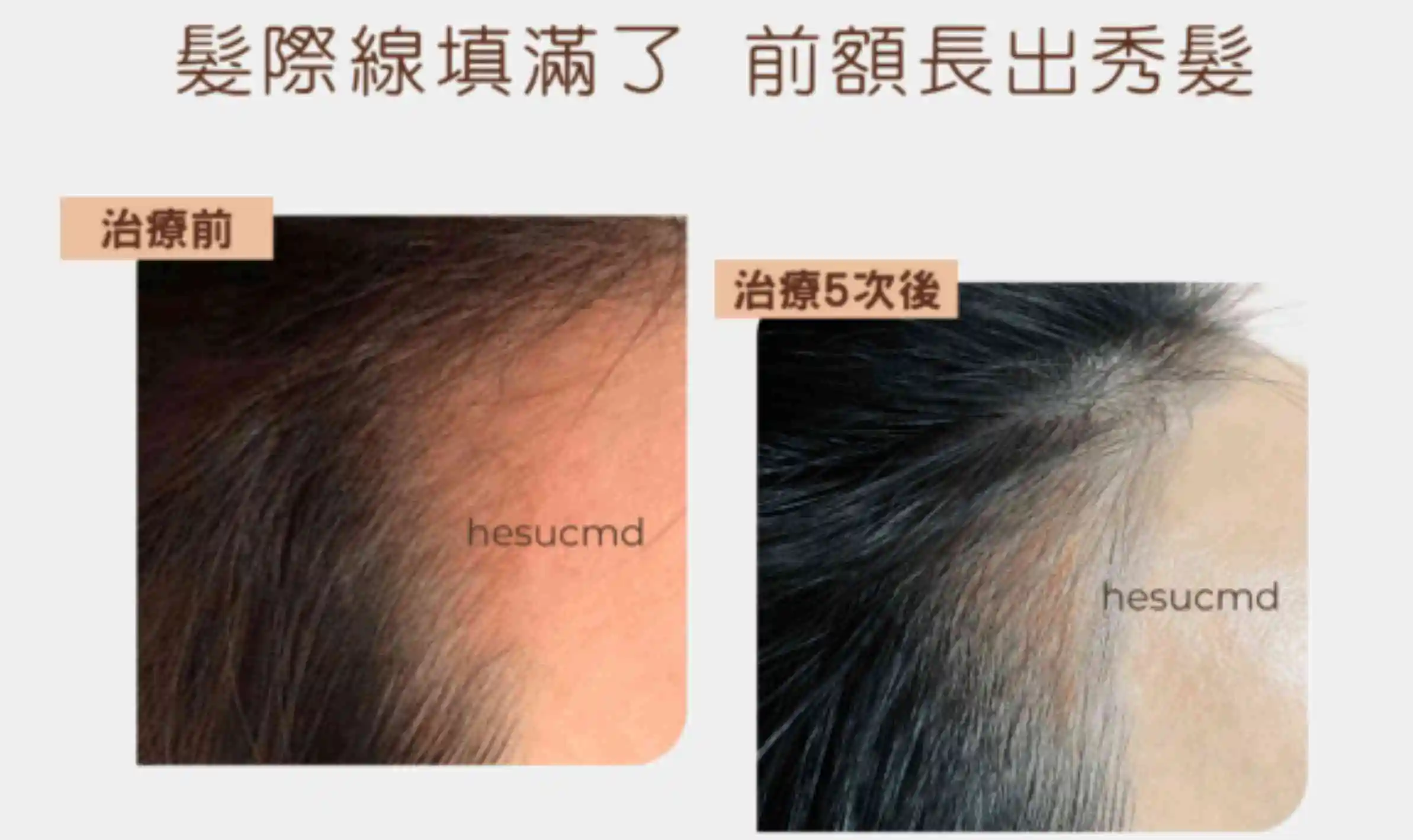 Alt="女士髮際線脫髮治療前後對比效果"